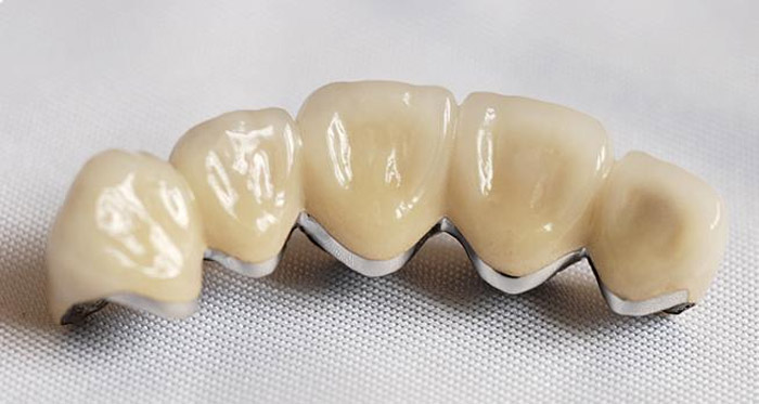 Ceramic Restorations The Fusion of Art and Nature in Modern Dentistry 2025